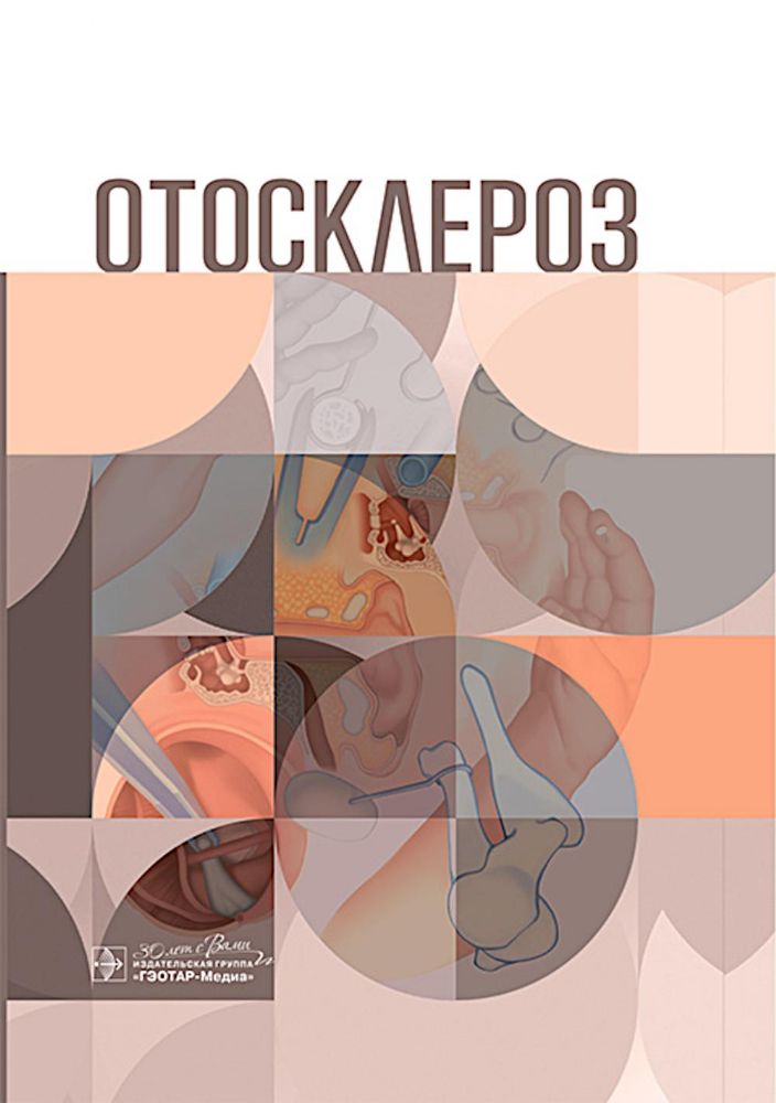 Отосклероз